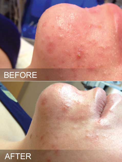 Before & After hydrafacial Oily skin brooklyn